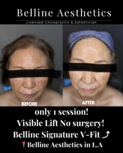before after pictures with k-glass facial