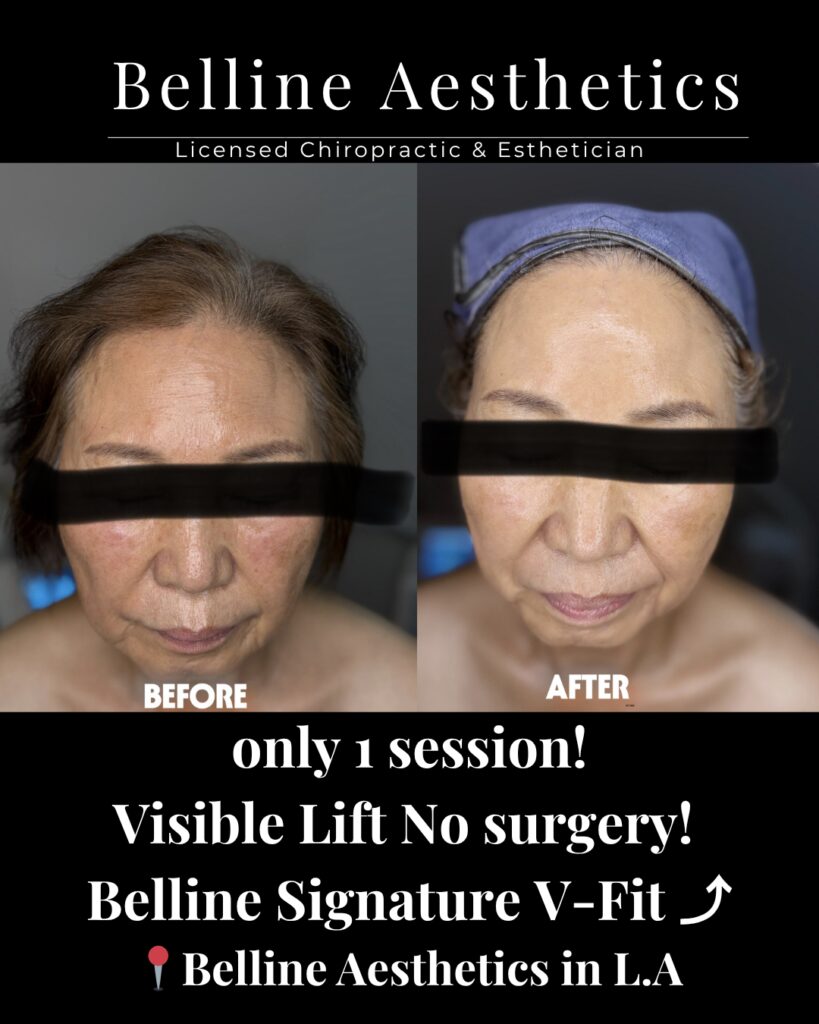 before after pictures with k-glass facial