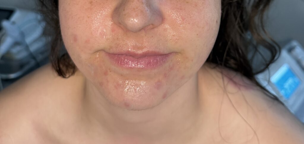 chin acne